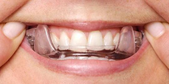 oral appliance therapy for osa