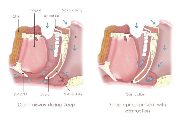 how is sleep apnea caused?